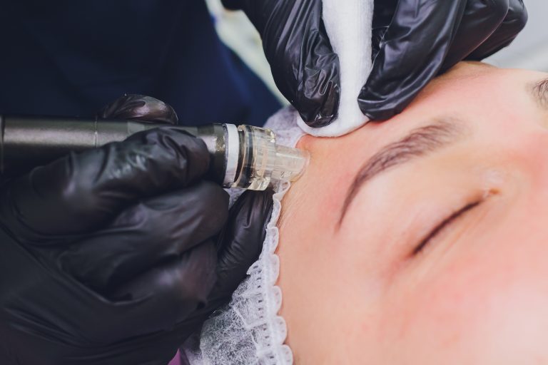 Dermabrasion girl's forehead. Instrumental cosmetology. Spa. Facial Rejuvenation. Mechanical peeling skin